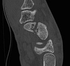 Scaphoid Humpback CT 2